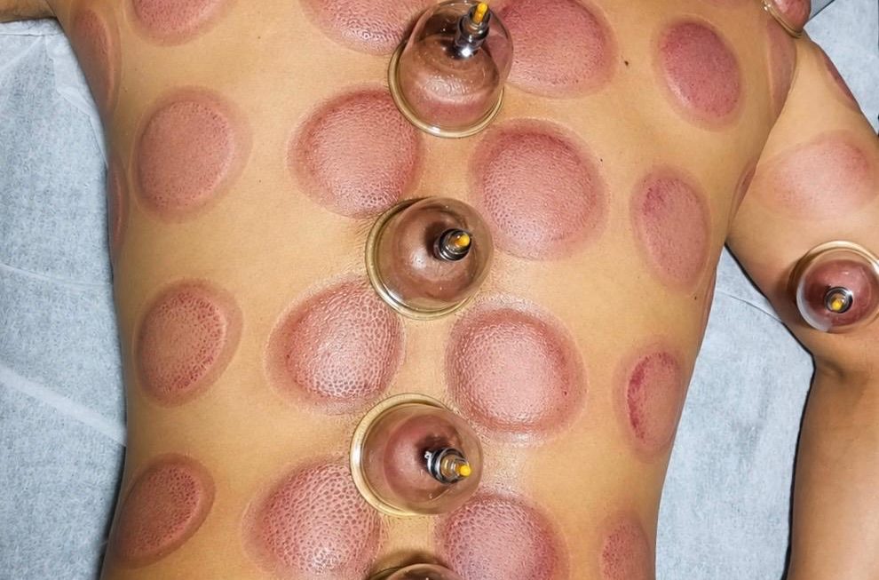 Cupping Therapy: An Old Practice That Is Now Part of Modern Wellness