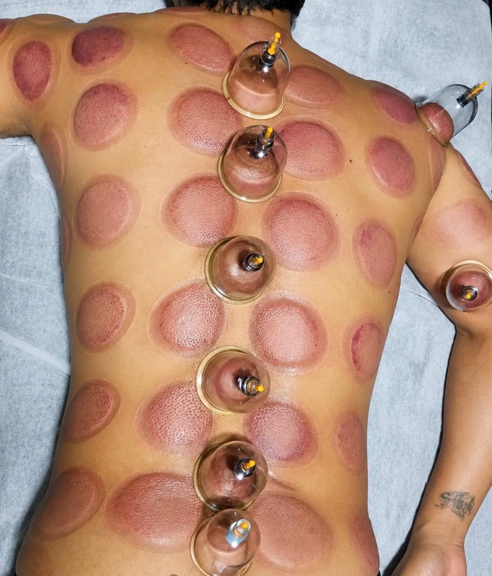 Cupping Therapy: An Old Practice That Is Now Part of Modern Wellness